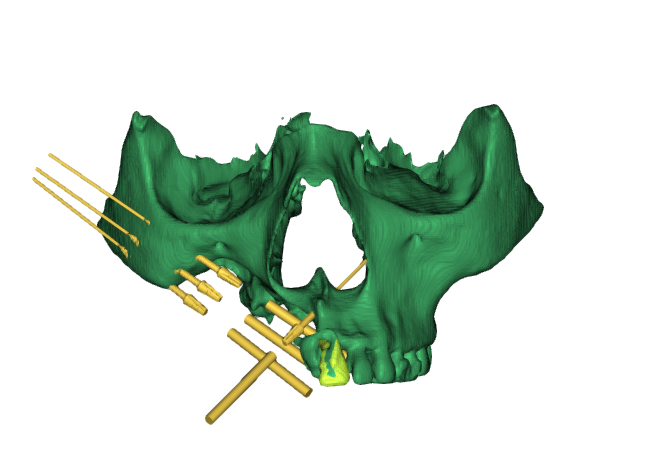 implant planning in zygoma