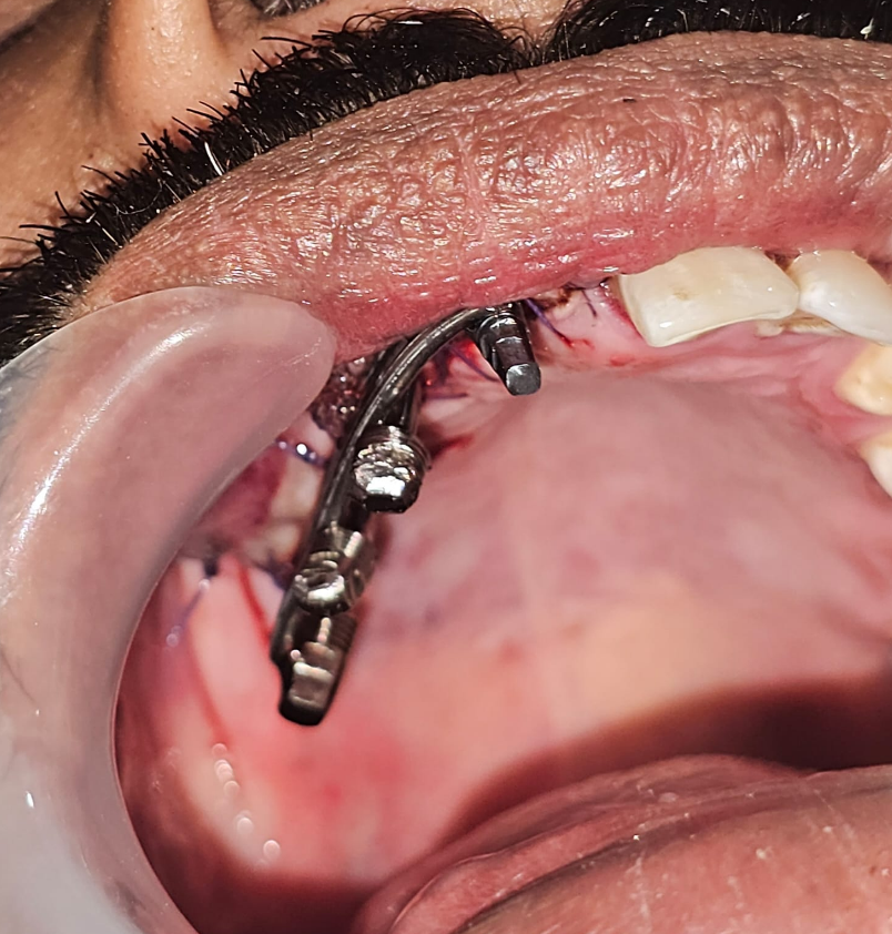 3 implant placed in zygoma