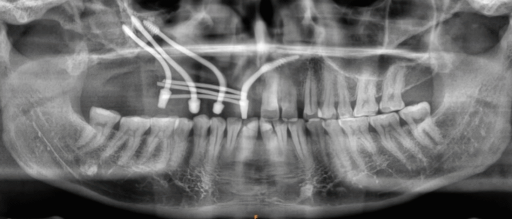 opg showing implants in zygoma